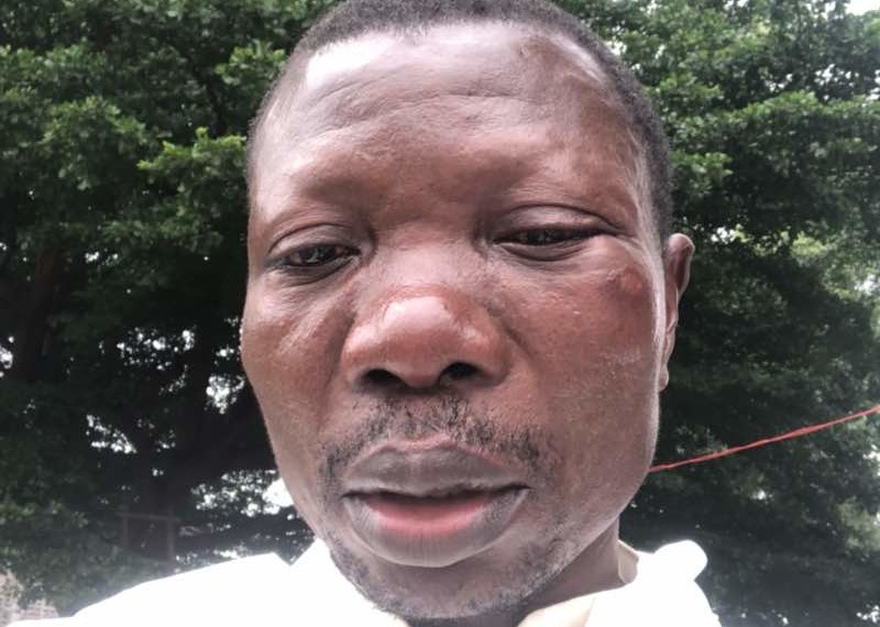 Father Jean was hit by a rubber bullet on his face during a peaceful demonstration at his parish St. Dominique on 31 December 2017.